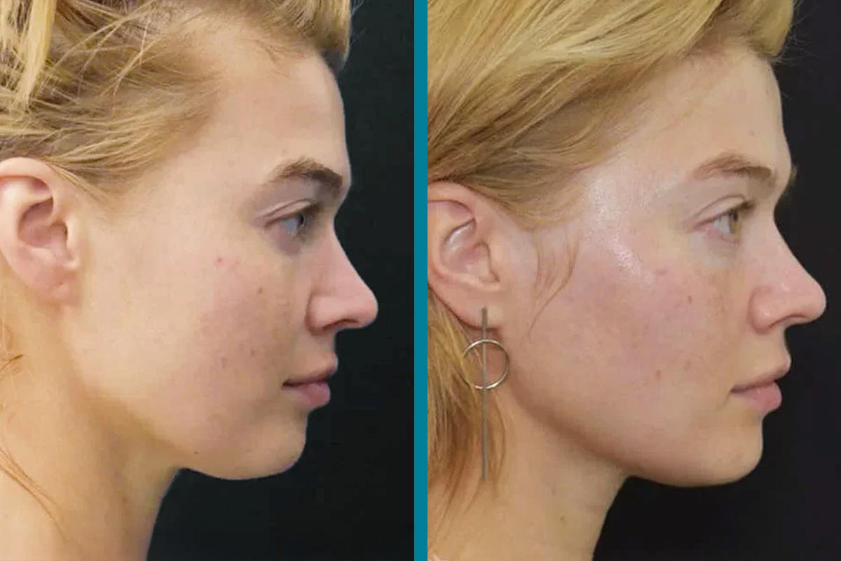 Ashley Before and After Results