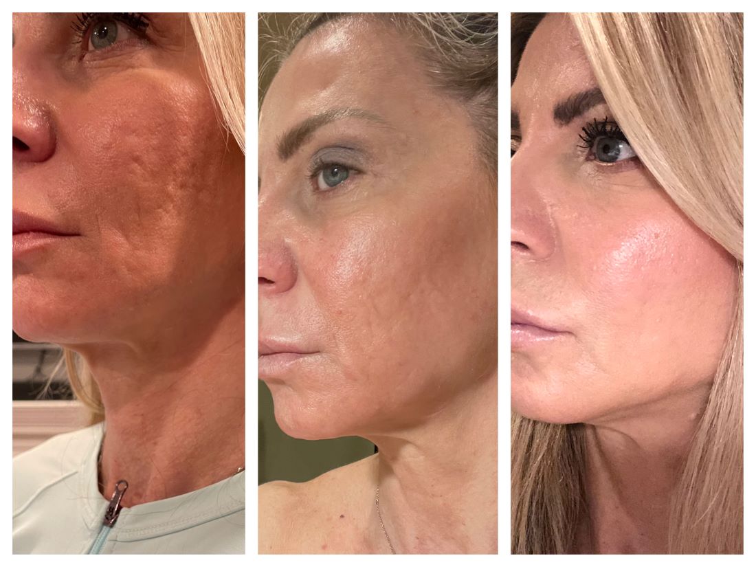 Jennifer Before and After Results