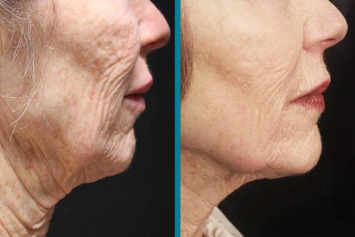 Sarah Before and After Results