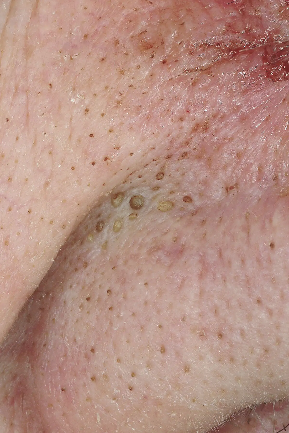Clinical close-up of small yellowish closed comedones in the crease beside the nose