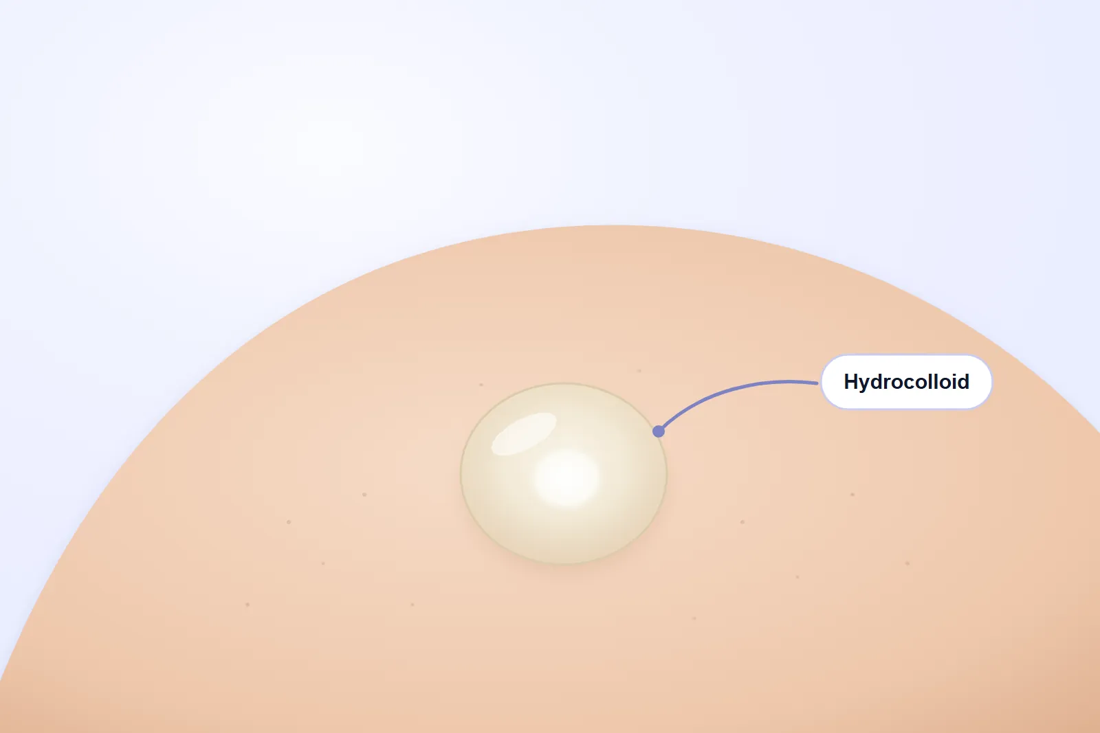 Illustration of a round hydrocolloid pimple patch on a cheek, turned white in the middle where it absorbed fluid
