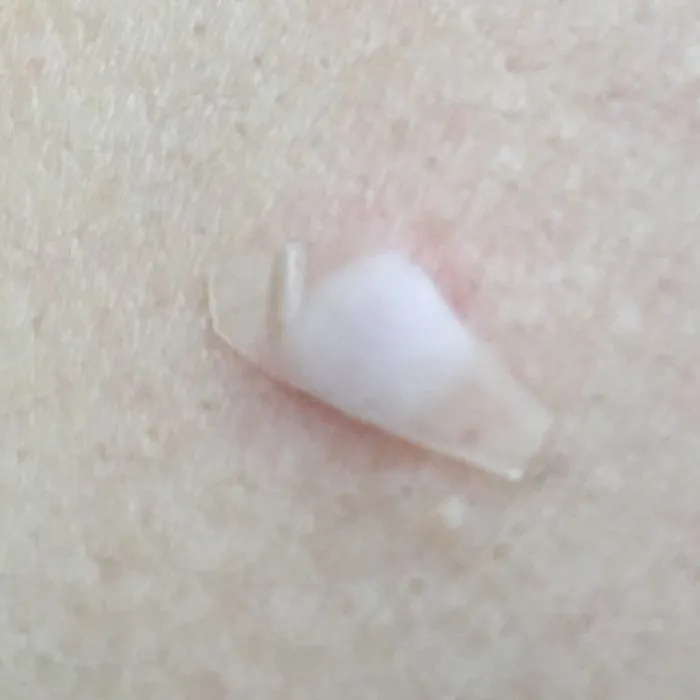 Small clear hydrocolloid patch on skin that has turned white in the middle after absorbing fluid