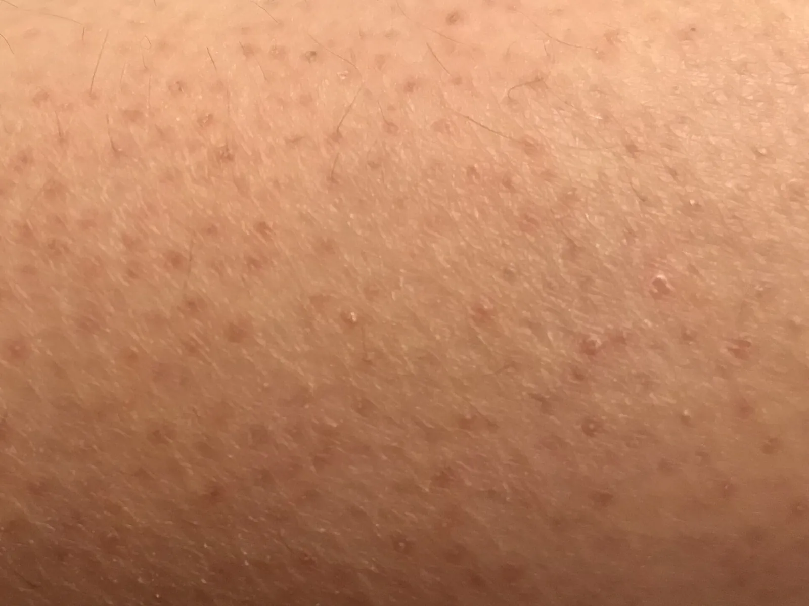 Close-up of keratosis pilaris: small rough bumps around the hair follicles on the skin of a calf