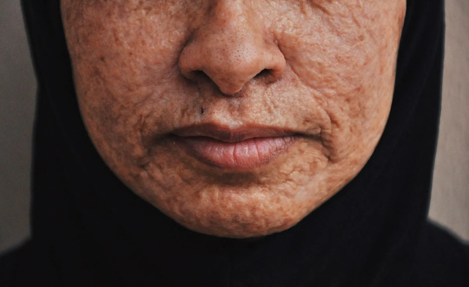 Lower face of an older woman with marionette lines running from the corners of her mouth toward her chin
