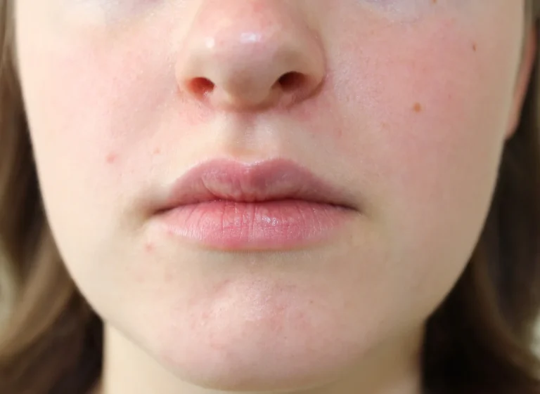 Close-up of red, irritated skin with small bumps around the nose, mouth and chin