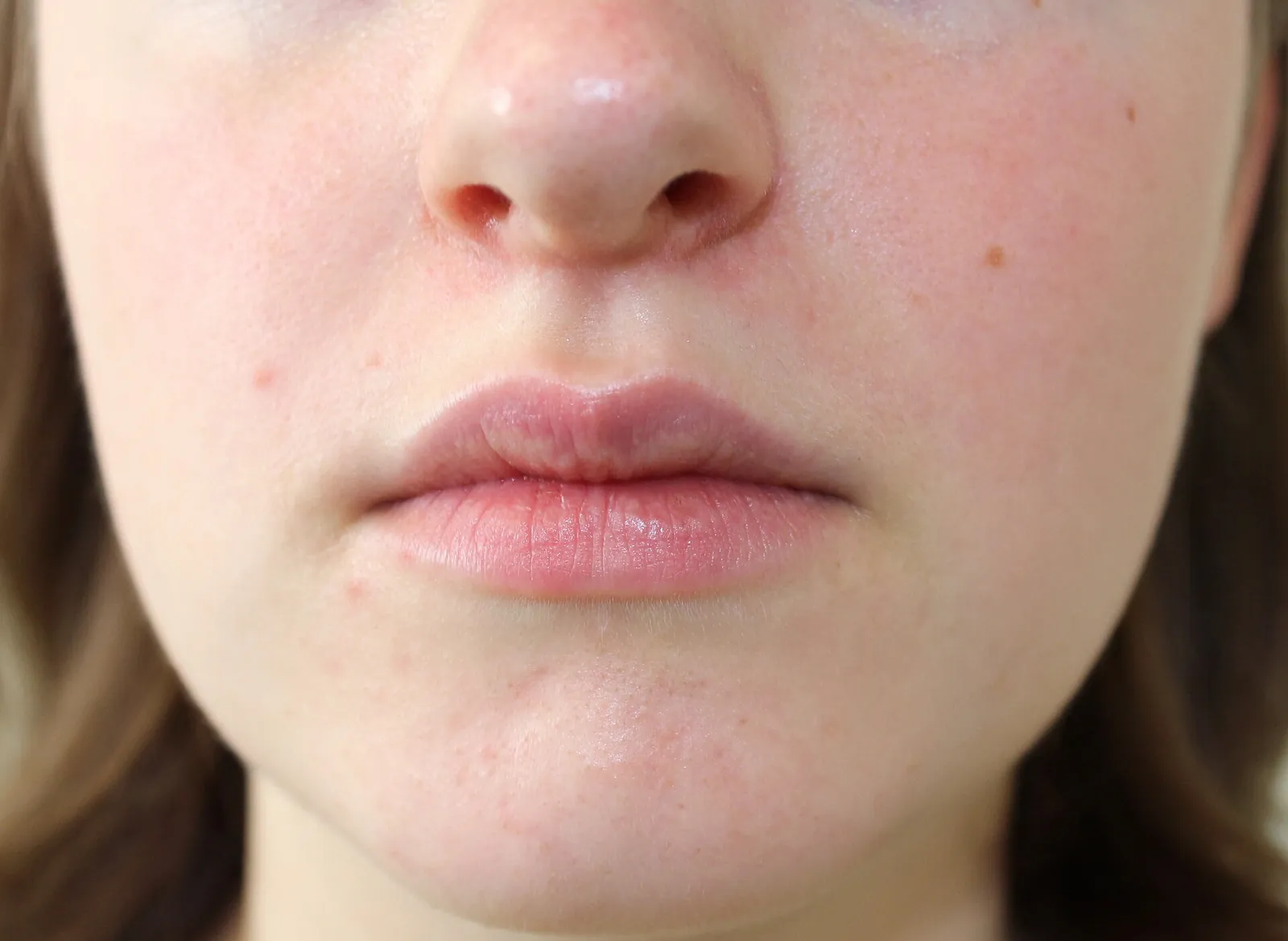 Close-up of red, irritated skin with small bumps around the nose, mouth and chin