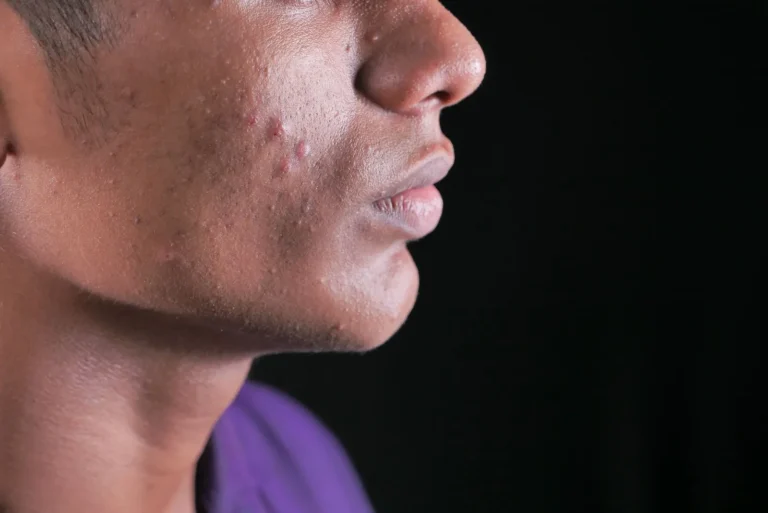 Close-up side view of a man's cheek and jawline with small red bumps and blemishes