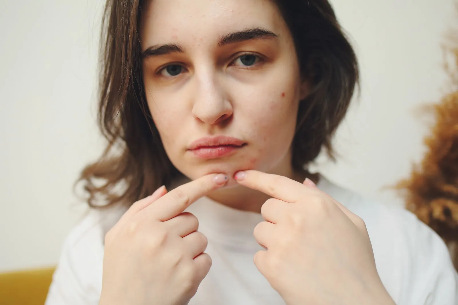 Woman pointing to small blemishes on her chin, with a few spots on her cheek