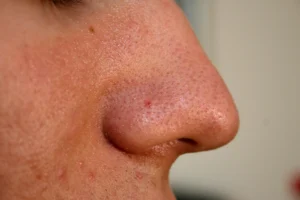 Close-up side view of a nose with tiny gray dots in the pores, the typical look of sebaceous filaments