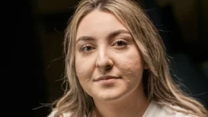 Close-up portrait of a woman with visible bumps and uneven texture across both cheeks