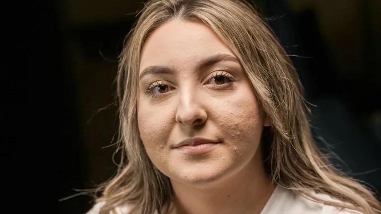 Close-up portrait of a woman with visible bumps and uneven texture across both cheeks