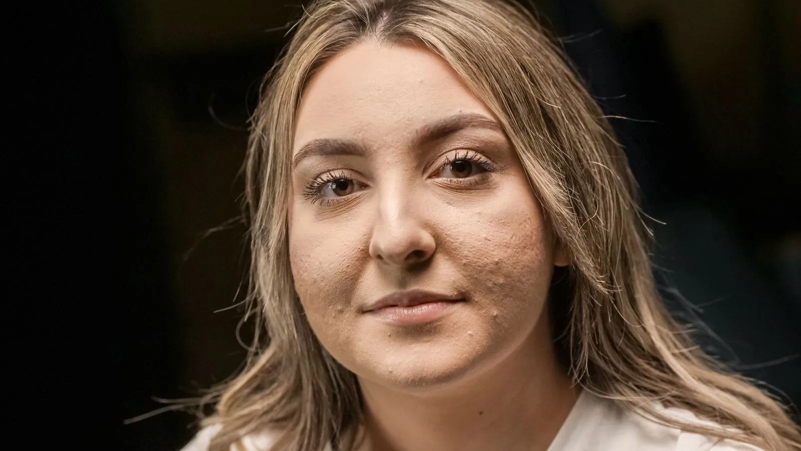 Close-up portrait of a woman with visible bumps and uneven texture across both cheeks