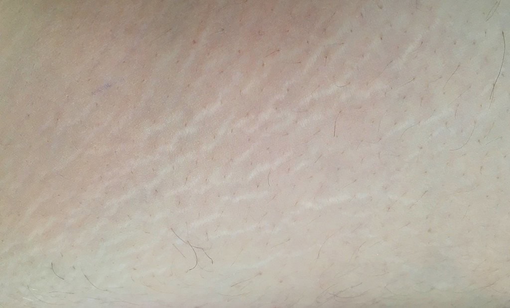 Silvery-white mature stretch marks on skin