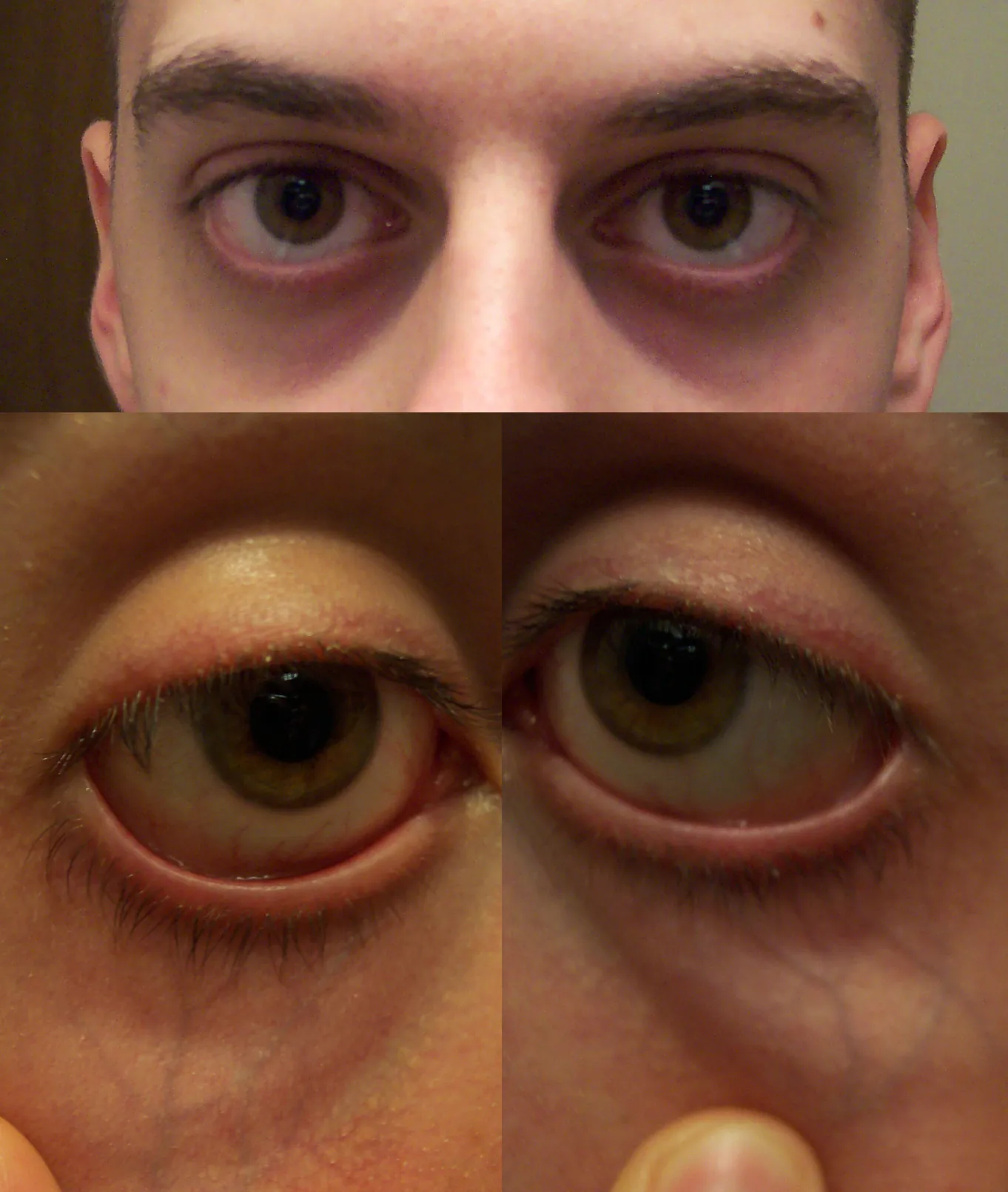 Adult face and close-ups of both lower lids showing dark under-eye circles with visible veins