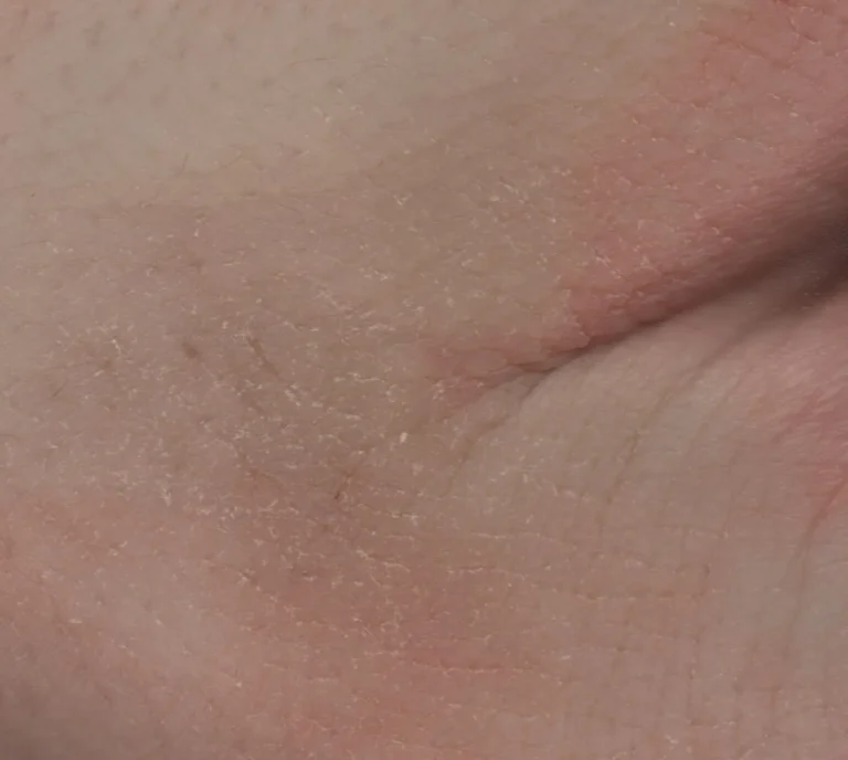 Close-up of dehydrated, flaky skin with fine surface cracks