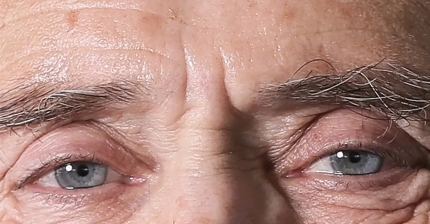 Deep vertical frown lines between an older man's eyebrows