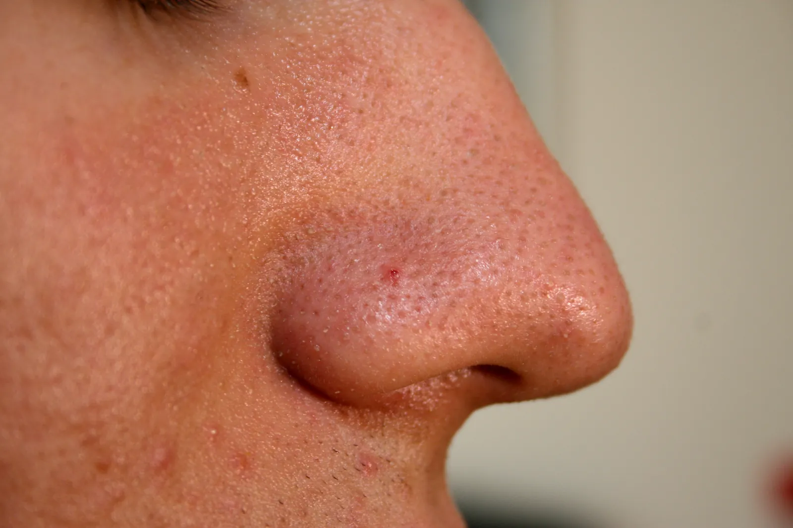 Close-up of a nose with open pores, a few blackheads and normal pore lining