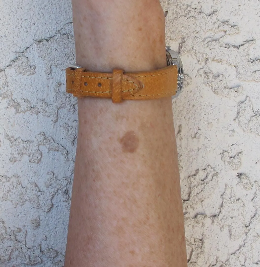 A single 10 mm sun spot, or solar lentigo, on the forearm of a 66-year-old woman near her watch strap