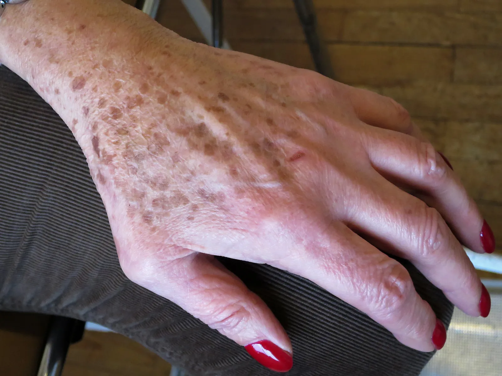 Solar lentigines, also called sun spots or age spots, scattered across the back of an older woman's hand